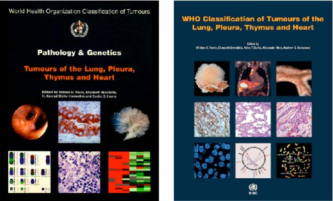 Figure 1: WHO classifications of tumours of the lung, pleura, thymus and heart published in 2004 (left) and 2015 (right)