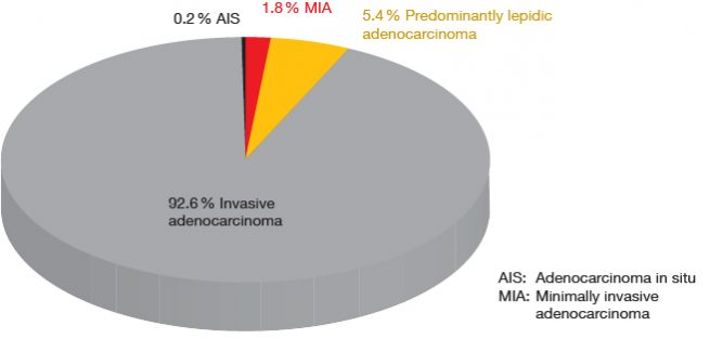 Figure 2: Frequency of adenocarcinoma in situ, minimally invasive adenocarcinoma, and predominantly lepidic adenocarcinoma, in 514 patients with stage I adenocarcinoma of the lung