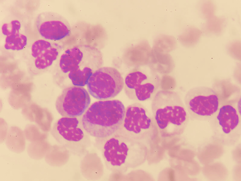 Image: Blood cells in Waldenström's macroglobulinemia